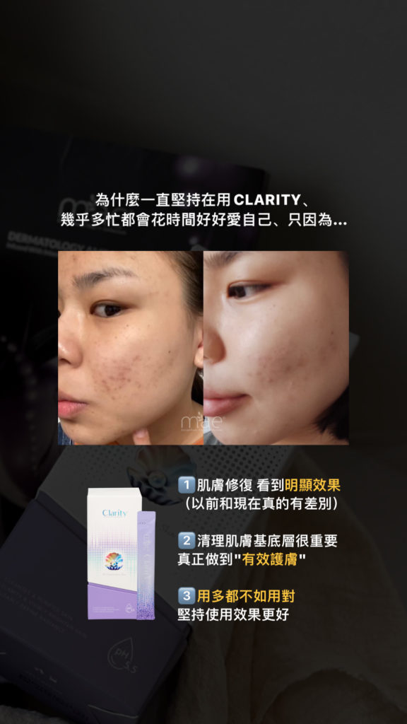 MAE clarity, mask ,skincare series,暗瘡產品,深層清潔,去角質