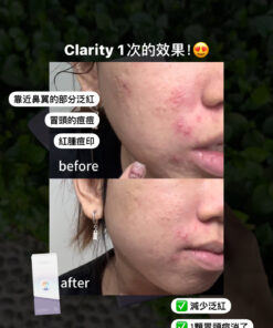 MAE clarity, mask ,skincare series,暗瘡產品,深層清潔,去角質